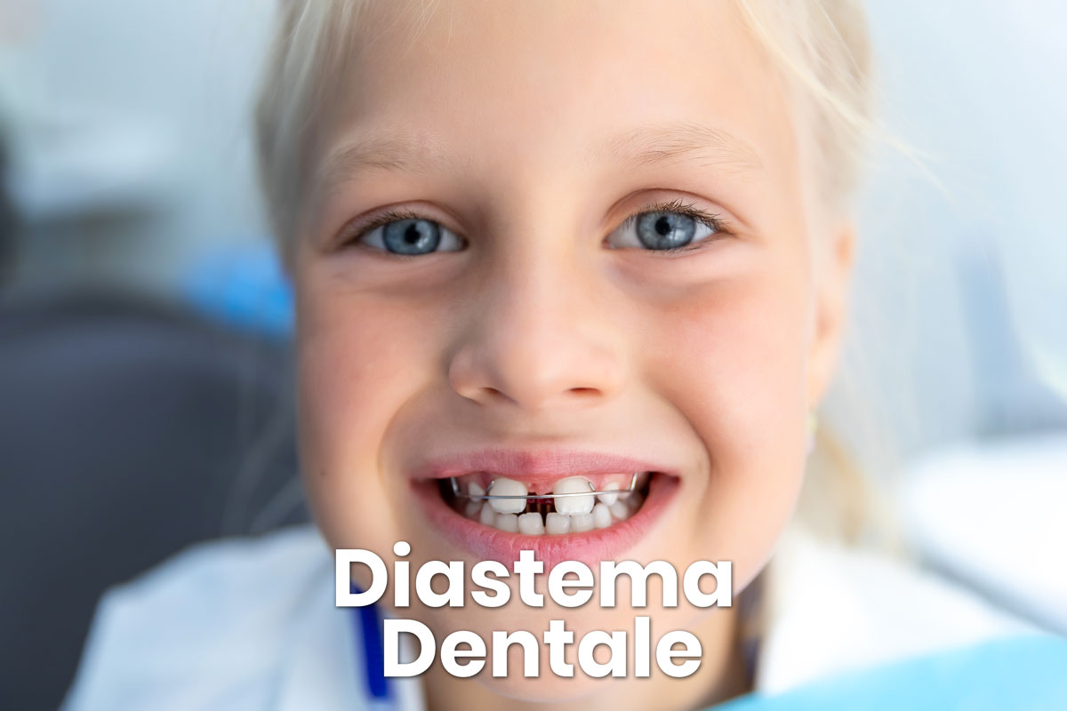 diastema dentale