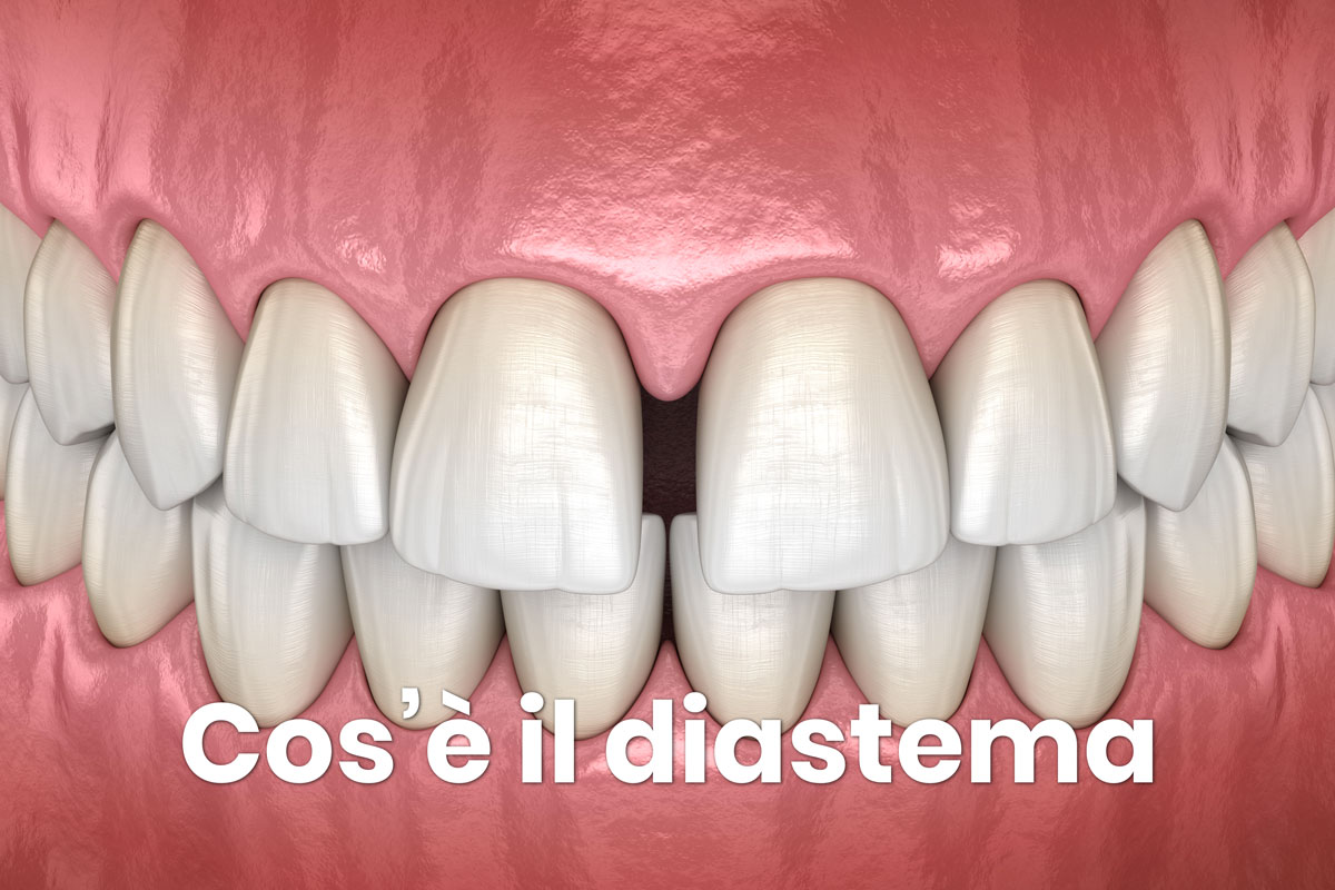 diastema