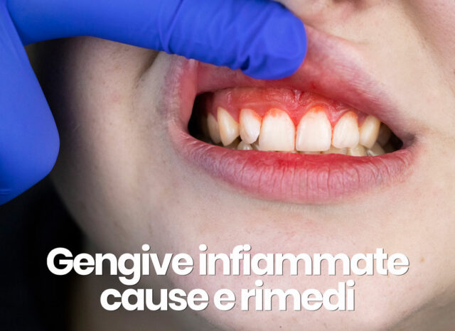 gengive infiammatissime cause e rimedi