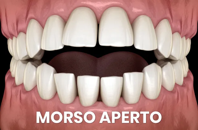 morso aperto frontale