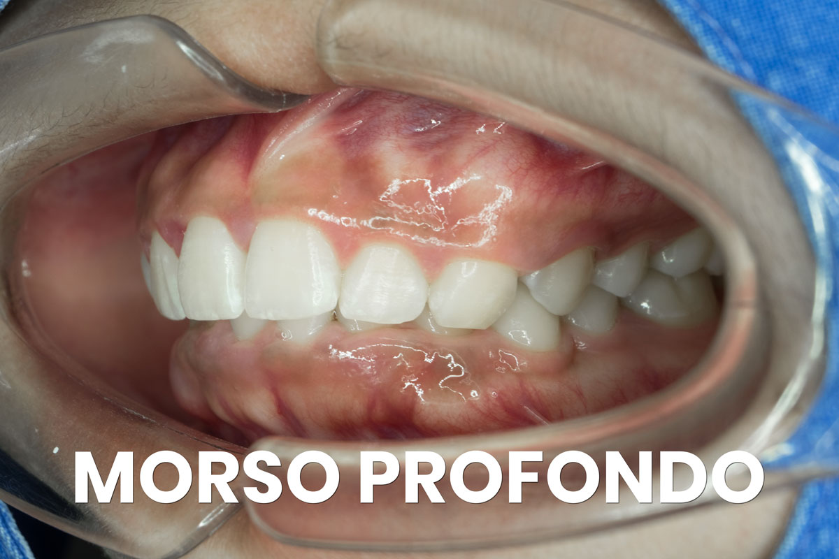 Qual è il costo di un apparecchio denti? Le varie tipologie - Centri  Dentistici Primo