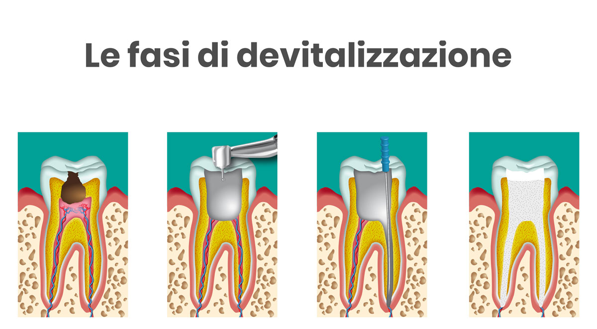 le fasi di devitalizzazione di un dente