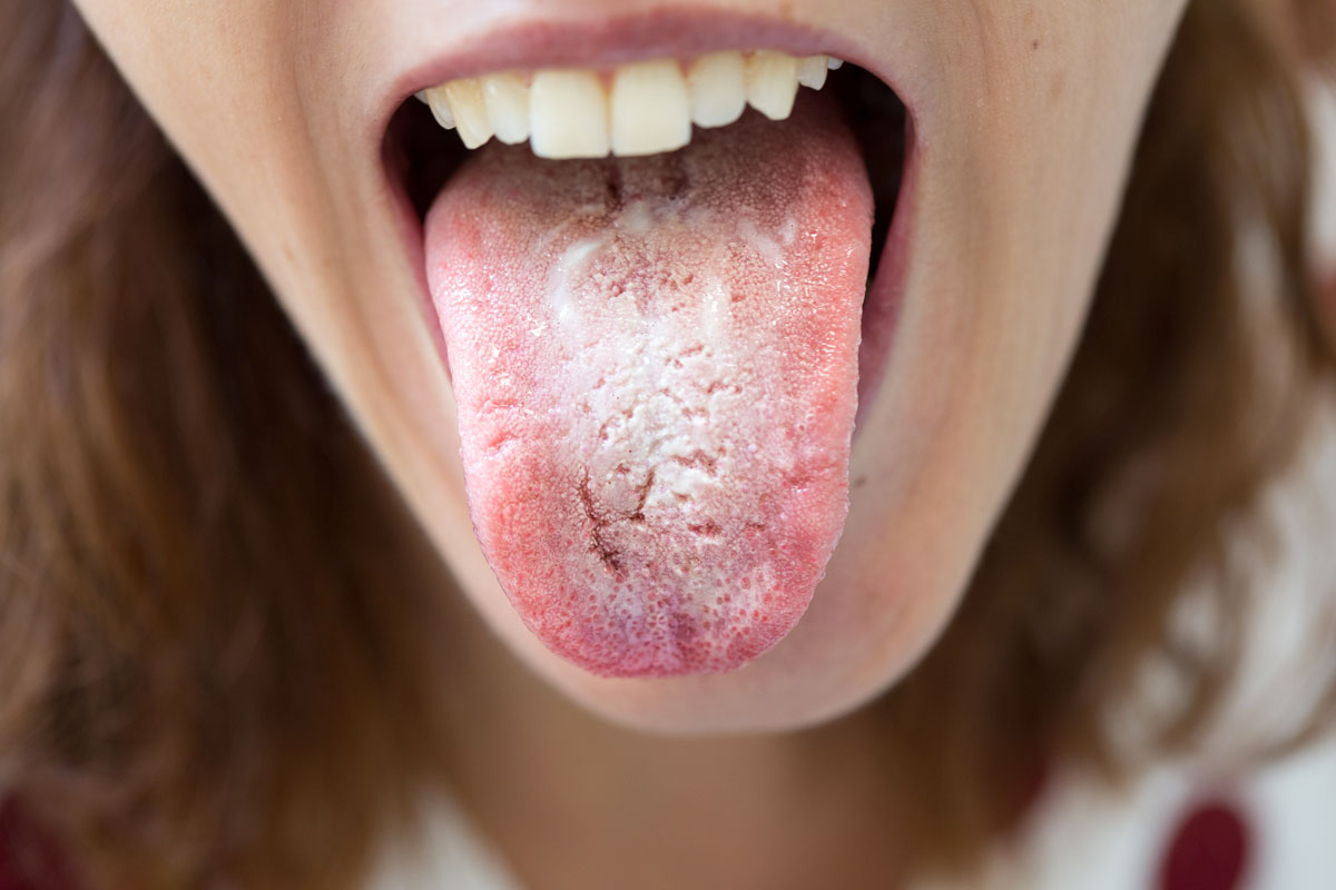 ragazza con lingua bianca da candida orale