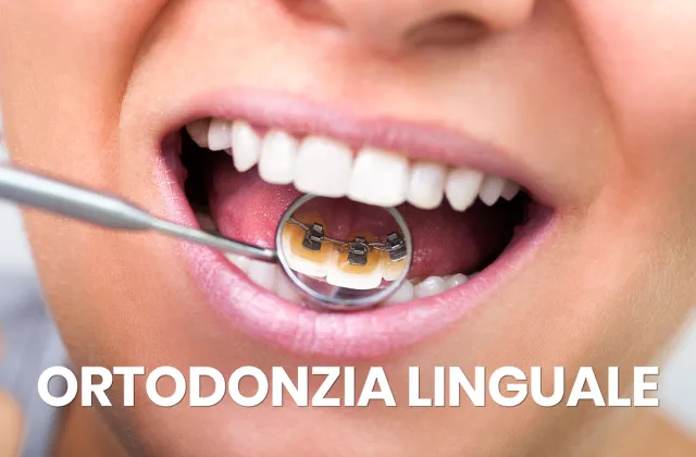 ortodonzia linguale