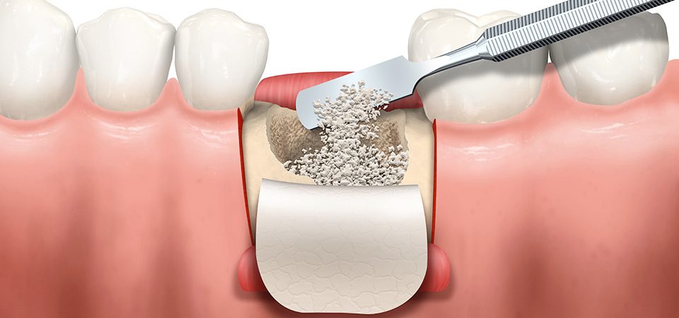 rigenerazione ossea denti