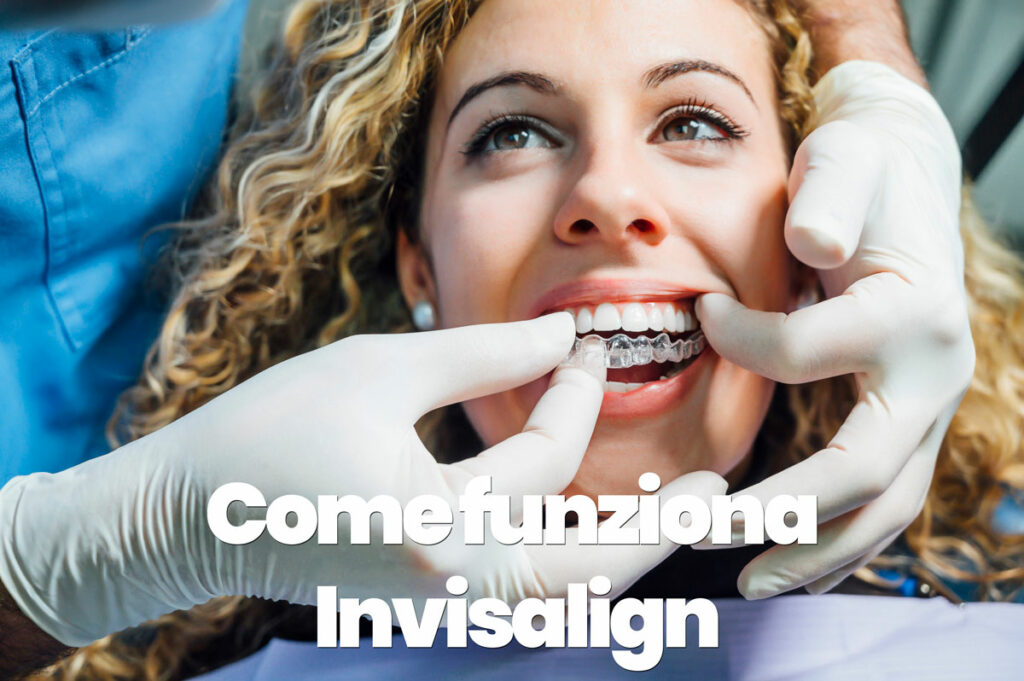 come funziona invisalign