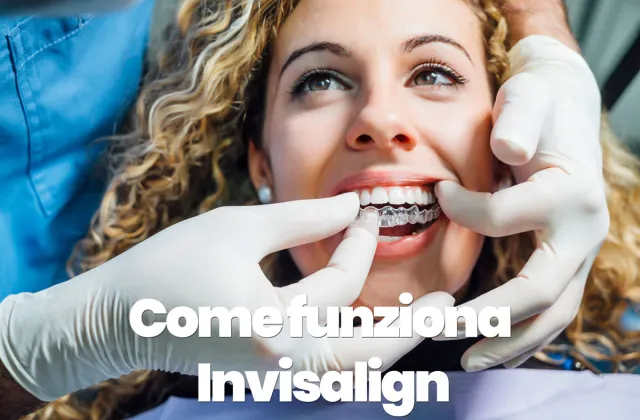 come funziona invisalign
