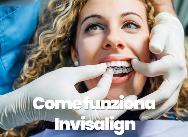 come funziona invisalign