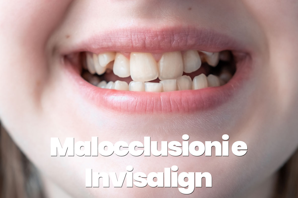 malocclusioni e invisalign