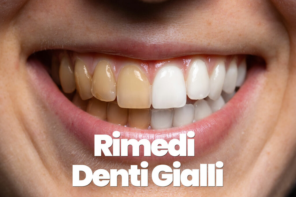 rimedi per i denti gialli