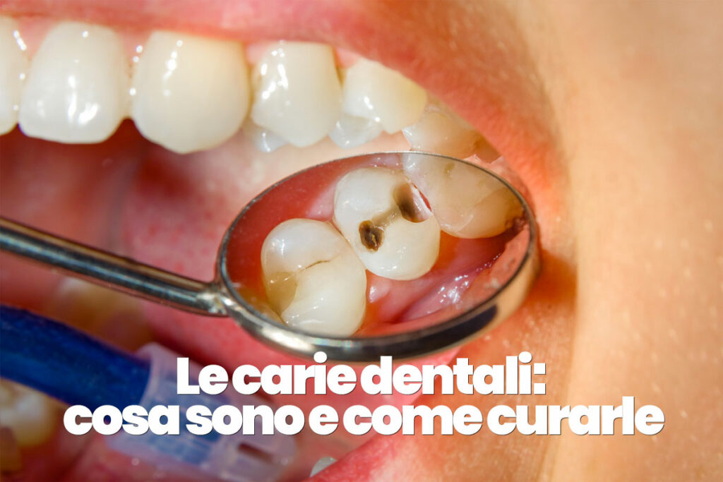 cosa sono le carie dentali e come curarle