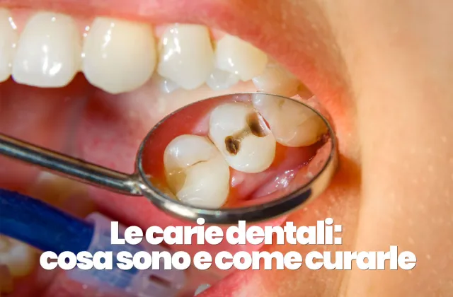 cosa sono le carie dentali e come curarle
