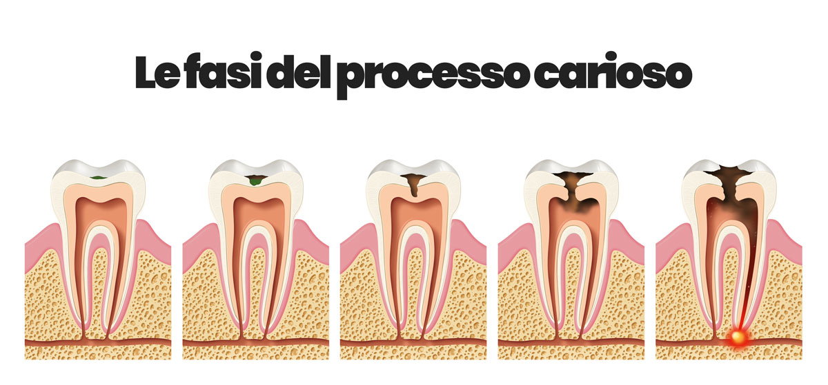 fasi delle carie dentali