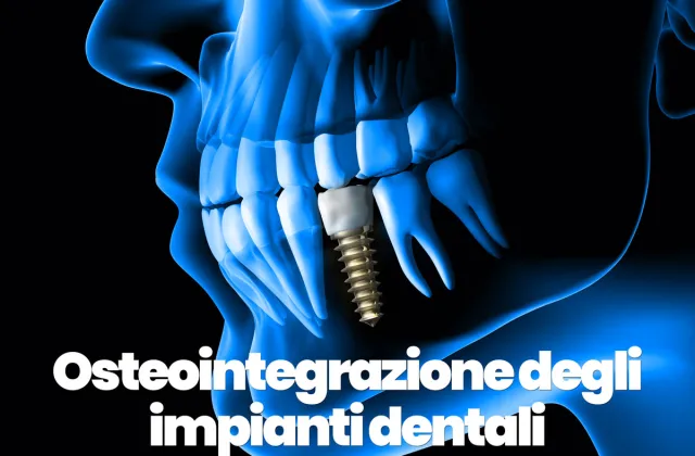 osteointegrazione degli impianti dentali