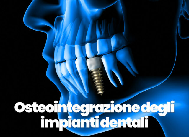 osteointegrazione degli impianti dentali