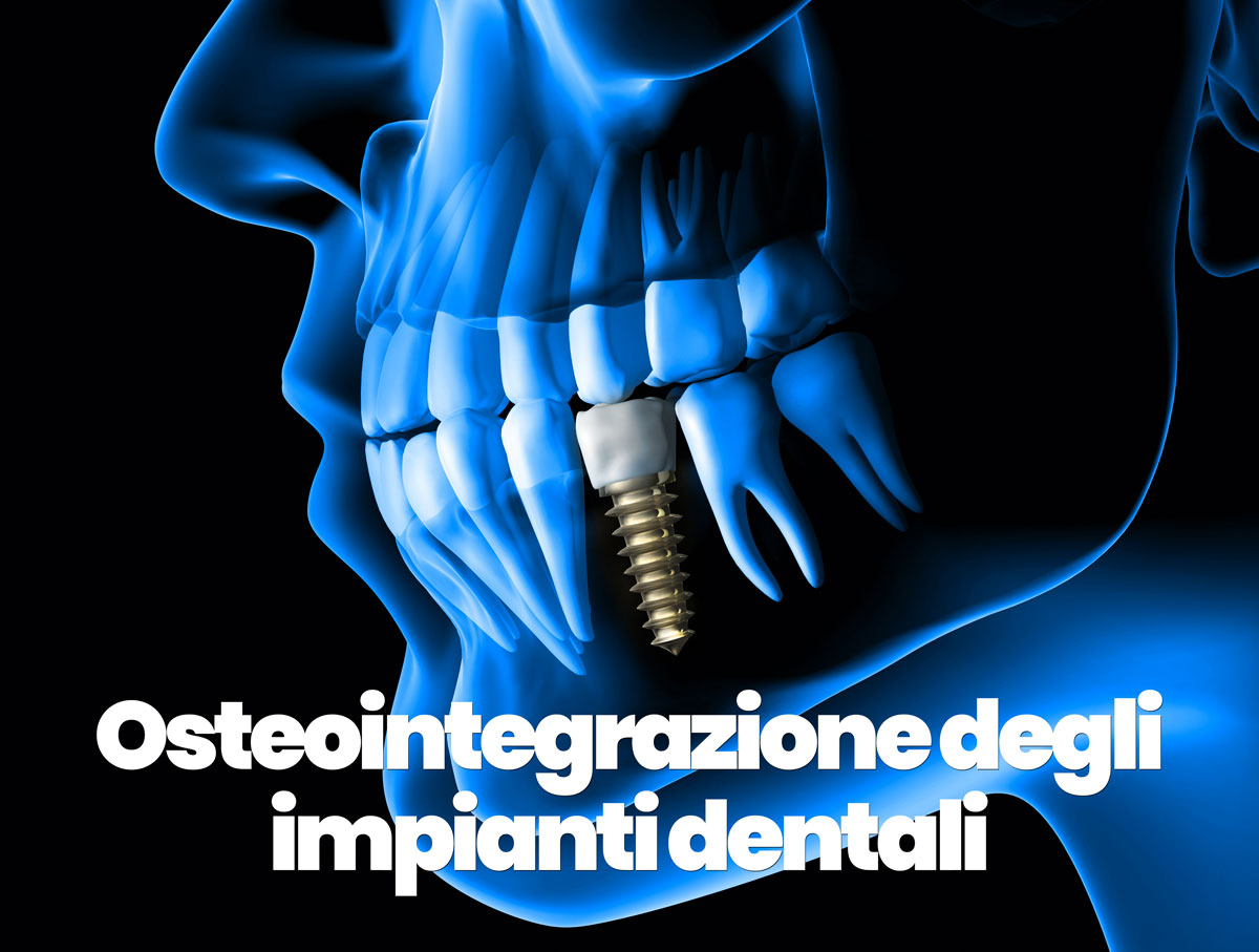 osteointegrazione degli impianti dentali