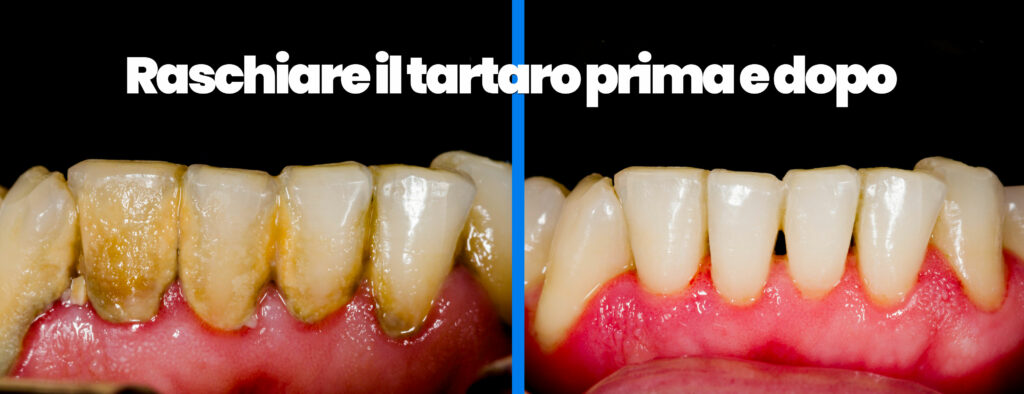 Come raschiare il tartaro: dal dentista e fai da te - Consigli Pratici