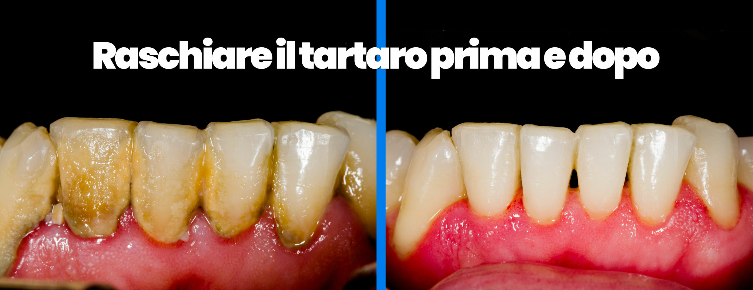 Come raschiare il tartaro: rimedi dal dentista e fai da te