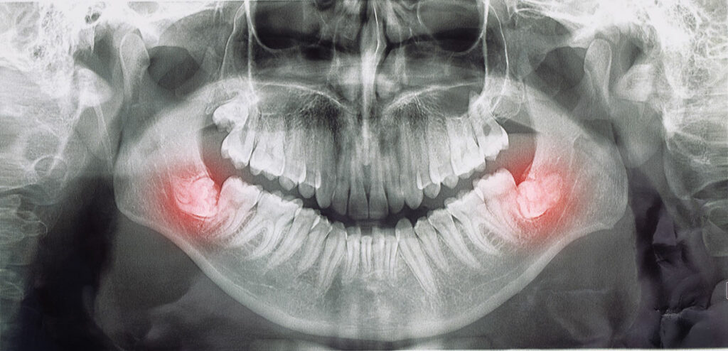 panoramica denti del giudizio inclinati