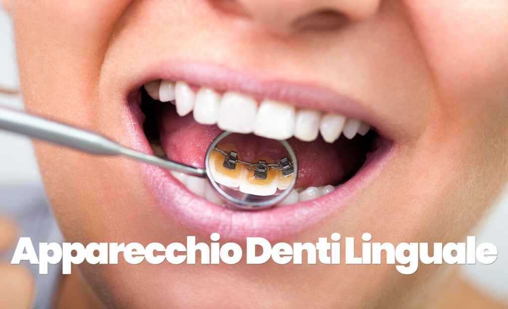 apparecchio denti linguale