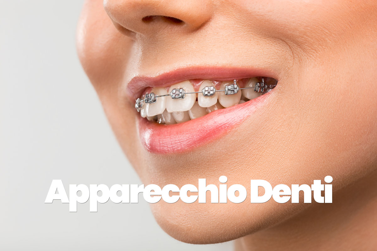 Denti: apparecchio invisibile. Per cosa si usa, benefici e consigli