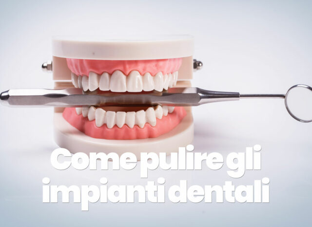 come pulire un impianto dentale