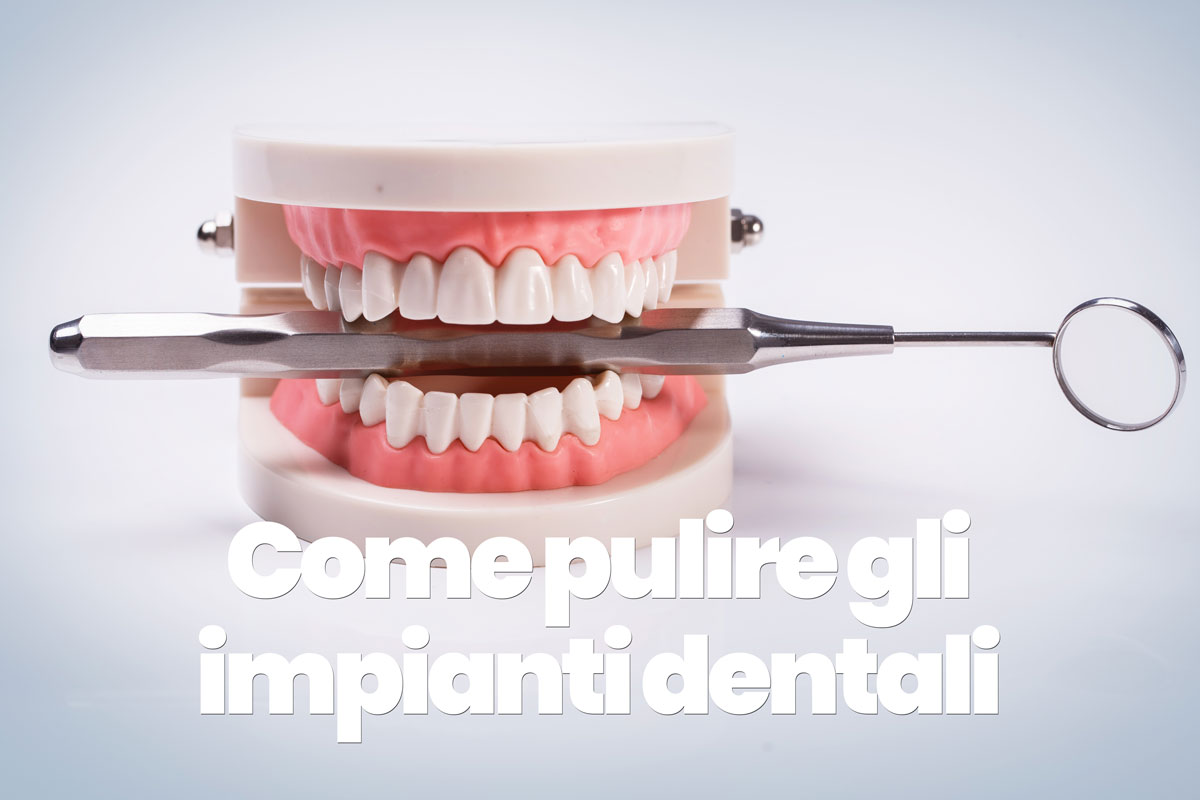 come pulire un impianto dentale