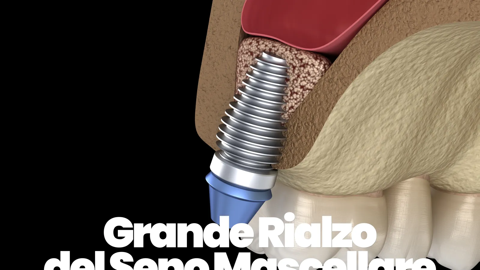 Grande rialzo del seno mascellare