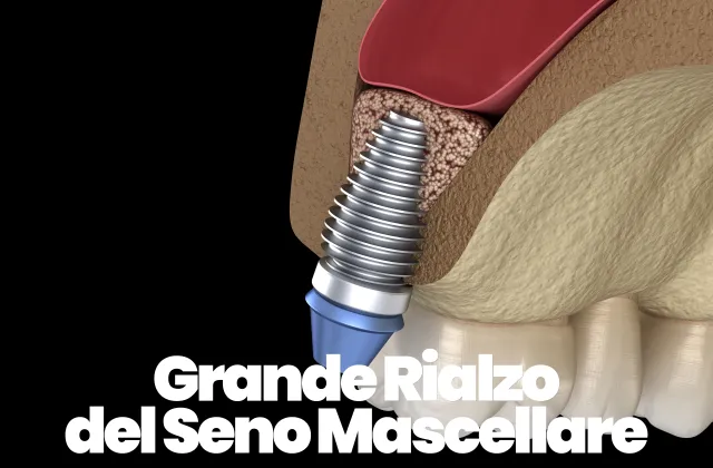Grande rialzo del seno mascellare