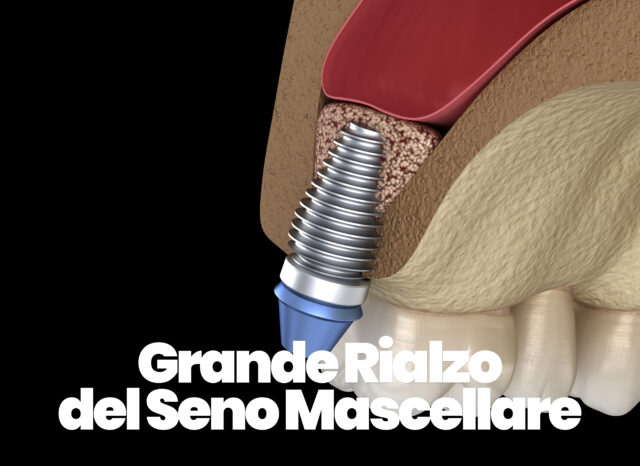 Grande rialzo del seno mascellare