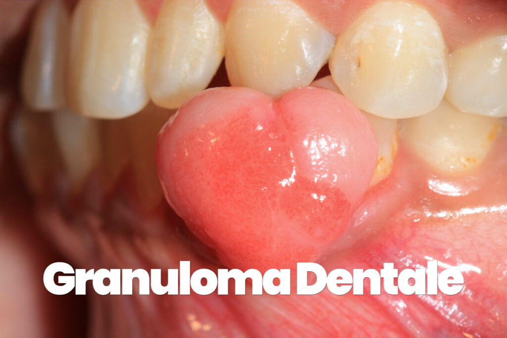 Cos'è il granuloma dentale: cause, sintomi e cura