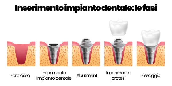 fasi inserimento impianto dentale