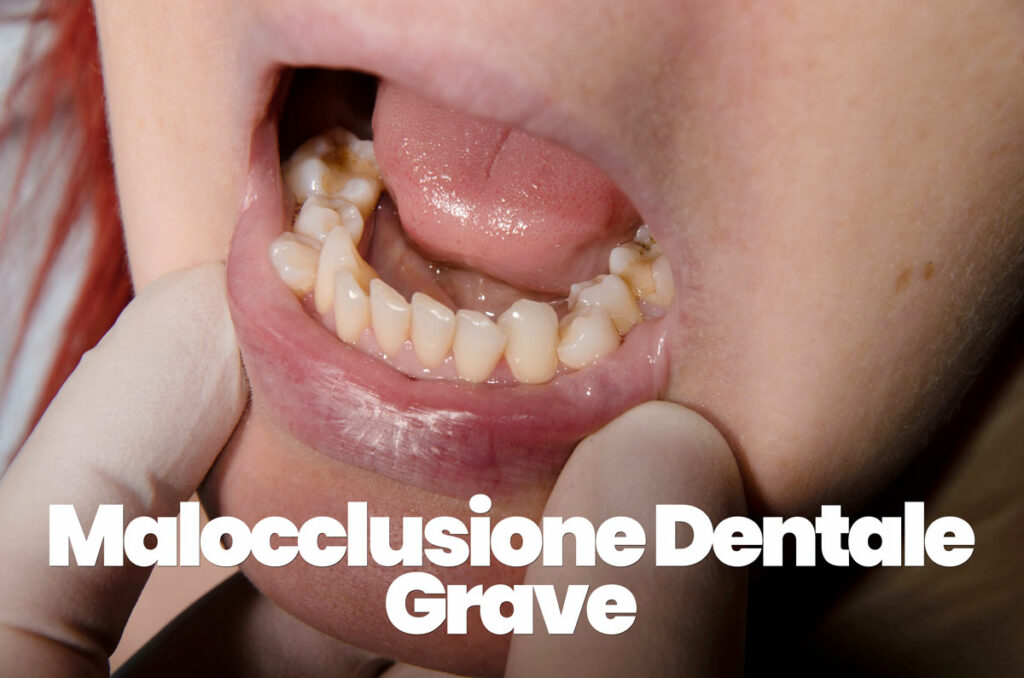 malocclusione dentale grave