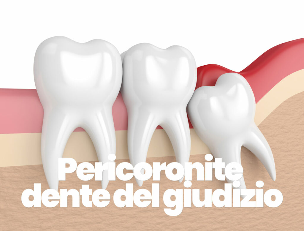 curare la pericoronite del dente del giudizio