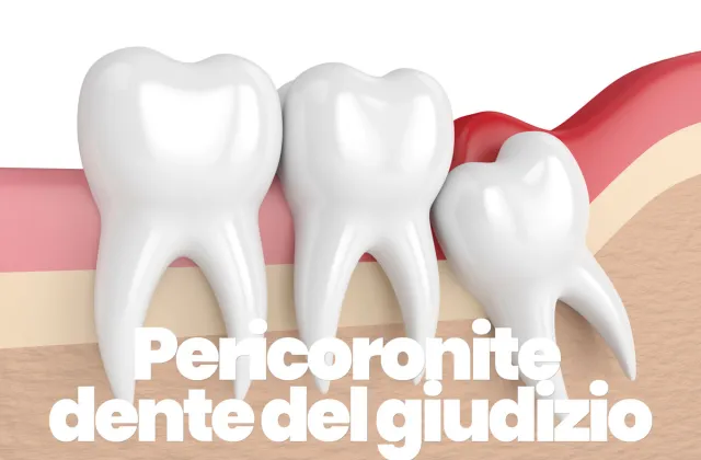 curare la pericoronite del dente del giudizio