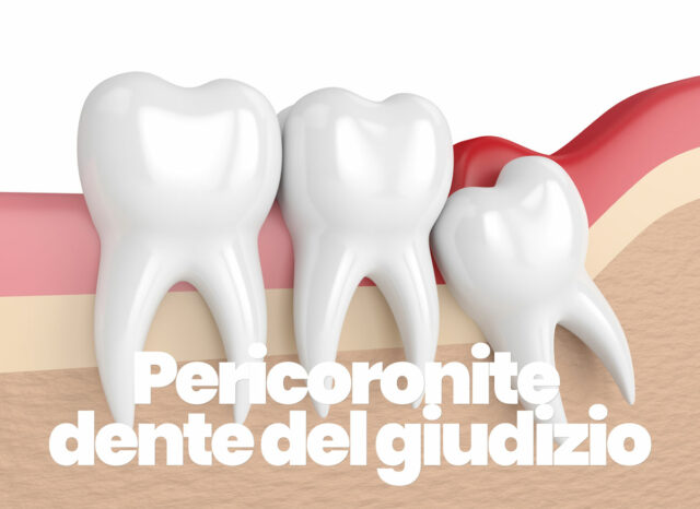 curare la pericoronite del dente del giudizio