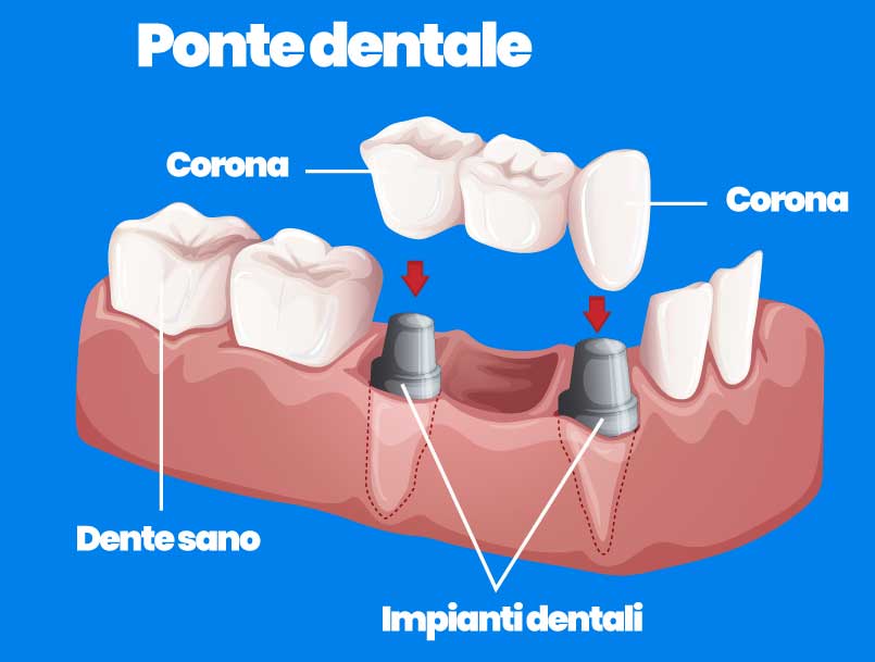 impianto dentale con ponte