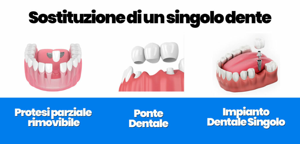 Rigetto impianto dentale: può avvenire Rigetto impianto dentale: può avvenire