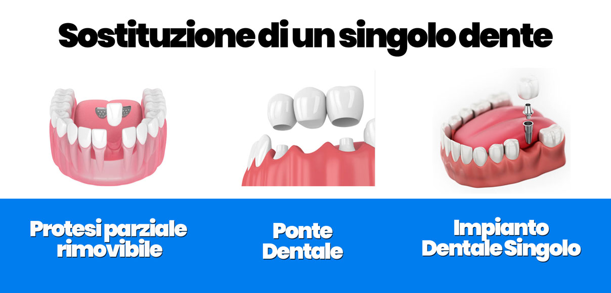 Protesi fissa su impianto dentale