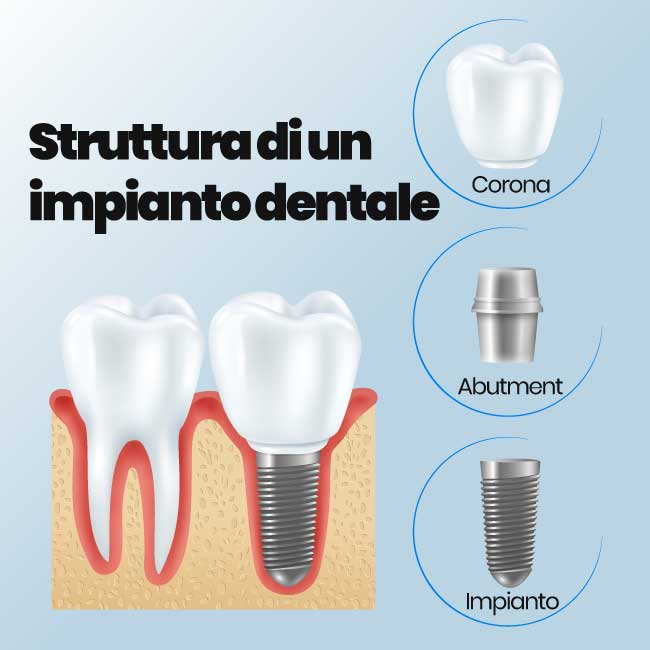 struttura di un impianto dentale