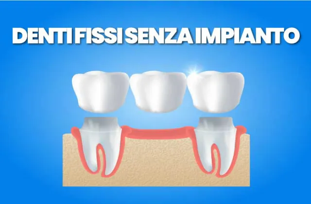 denti fissi senza impianto