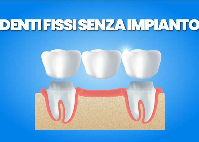 denti fissi senza impianto