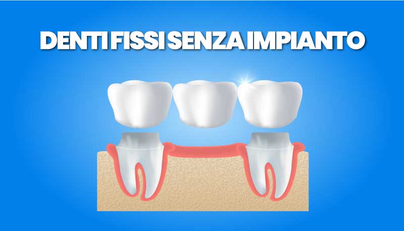 Denti fissi senza impianto, Risparmia tempo e denaro