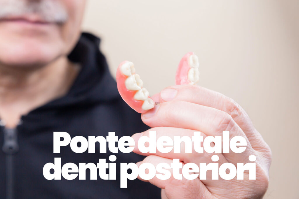 ponte dentale per denti posteriori