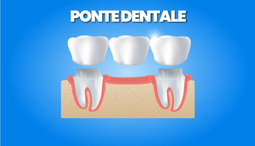 ponte dentale su denti naturali