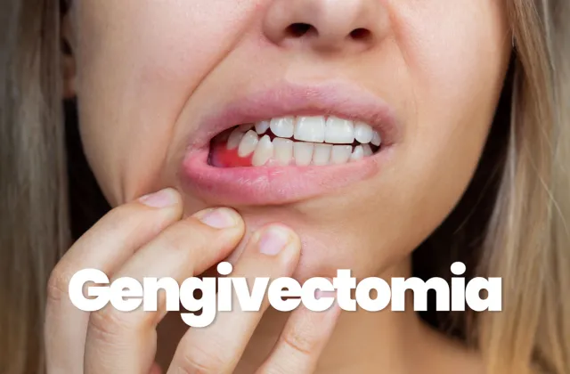 Gengivectomia cos'è equando farla