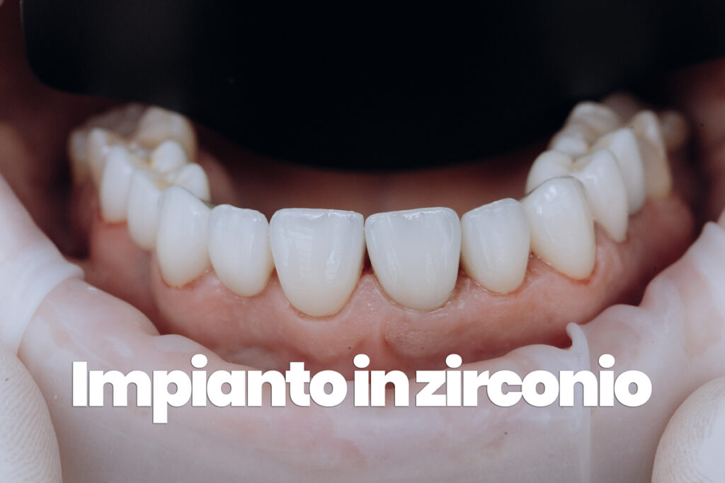 impianto dentale in zirconia definitivo