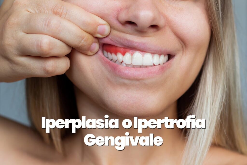 iperplasia gengivale