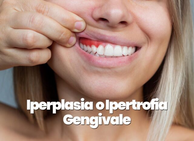 iperplasia gengivale