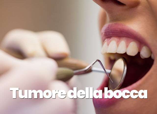 tumore della bocca